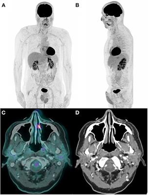 Case Report: Nasal Cavity Epithelial-Myoepithelial Carcinoma With High Fluoro-D-Glucose Uptake on Positron Emission Tomography/Computed Tomography